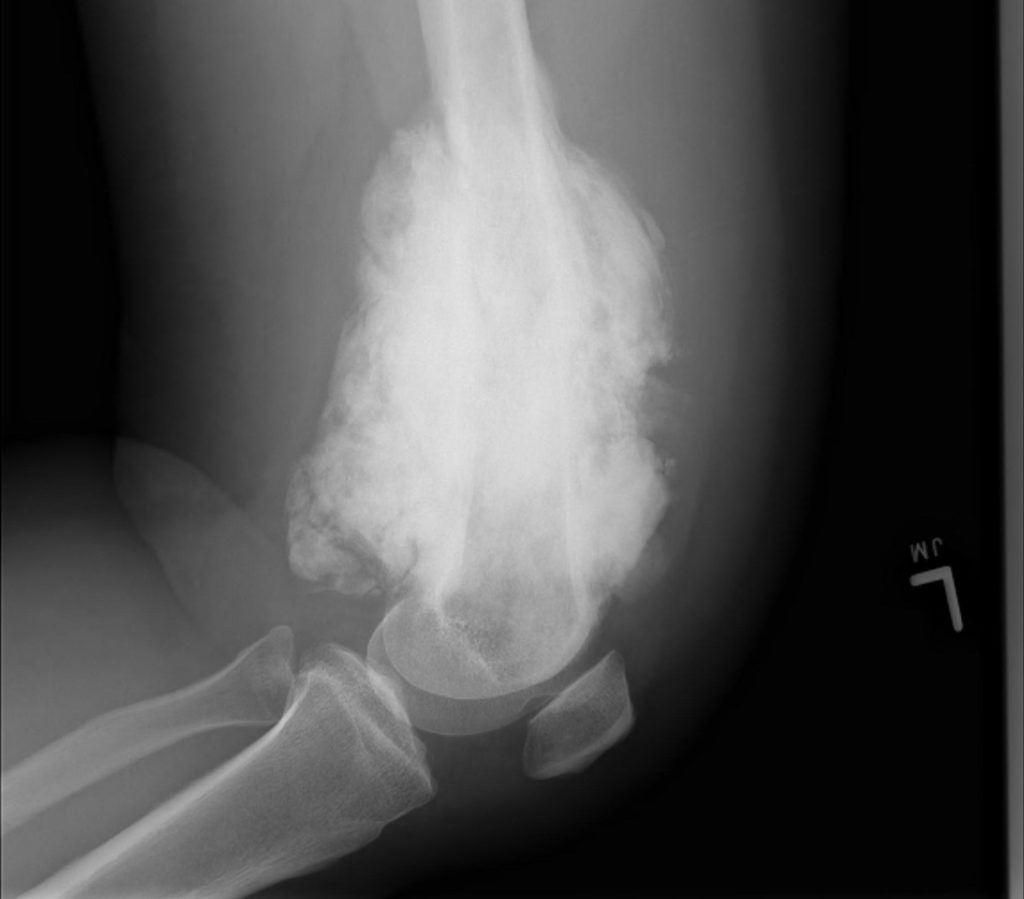 Osteosarcoma Distal Femur0002